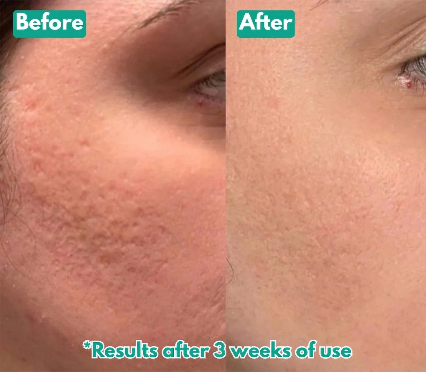 Opelle™ Spicule Serum